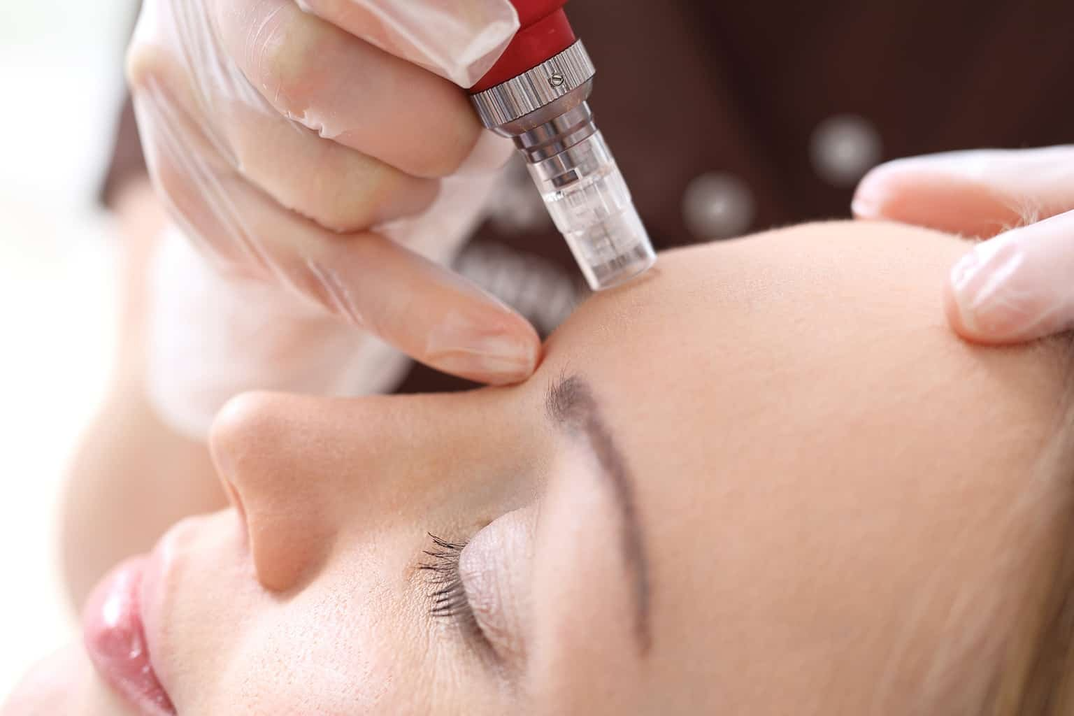 Mezoterapia cu microneedling- avataje si principiul de functionare